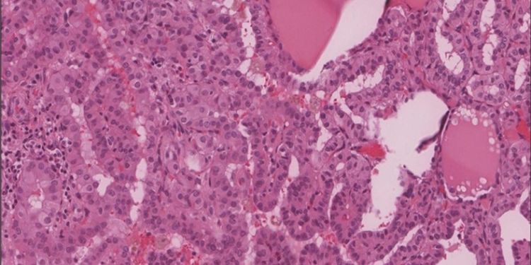 Article: Primary Leiomyosarcoma of the Thyroid; a Case  Report and a Review of Recent Literature