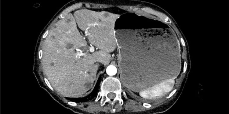 Article: Massive Hematemesis as Initial Presentation of Advanced Pancreatic Adenocarcinoma