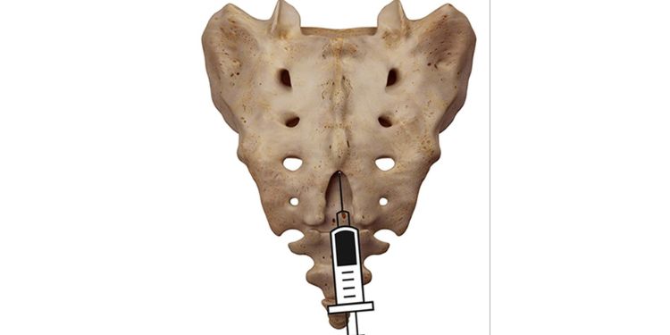 Article: The Useful Conclusion in our Experience Regarding the Sacral Injection