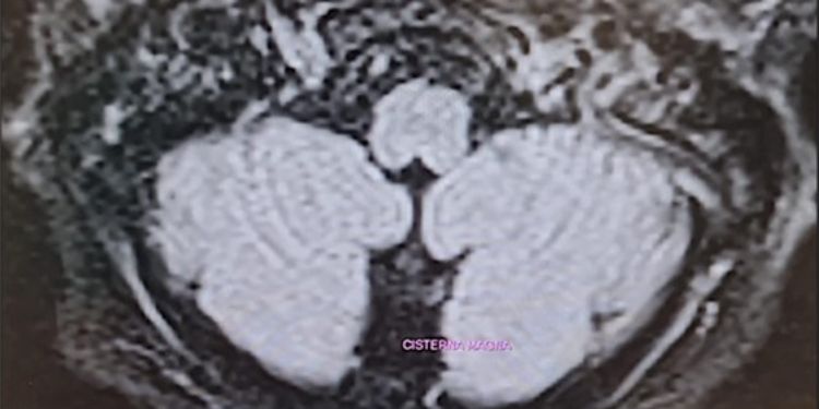 Article: Acute Hypomagnesemia-Induced Cerebellar Down-Beat Nystagmus Syndrome Due to Benign Paroxysmal Positional Vertigo: A Case Report 